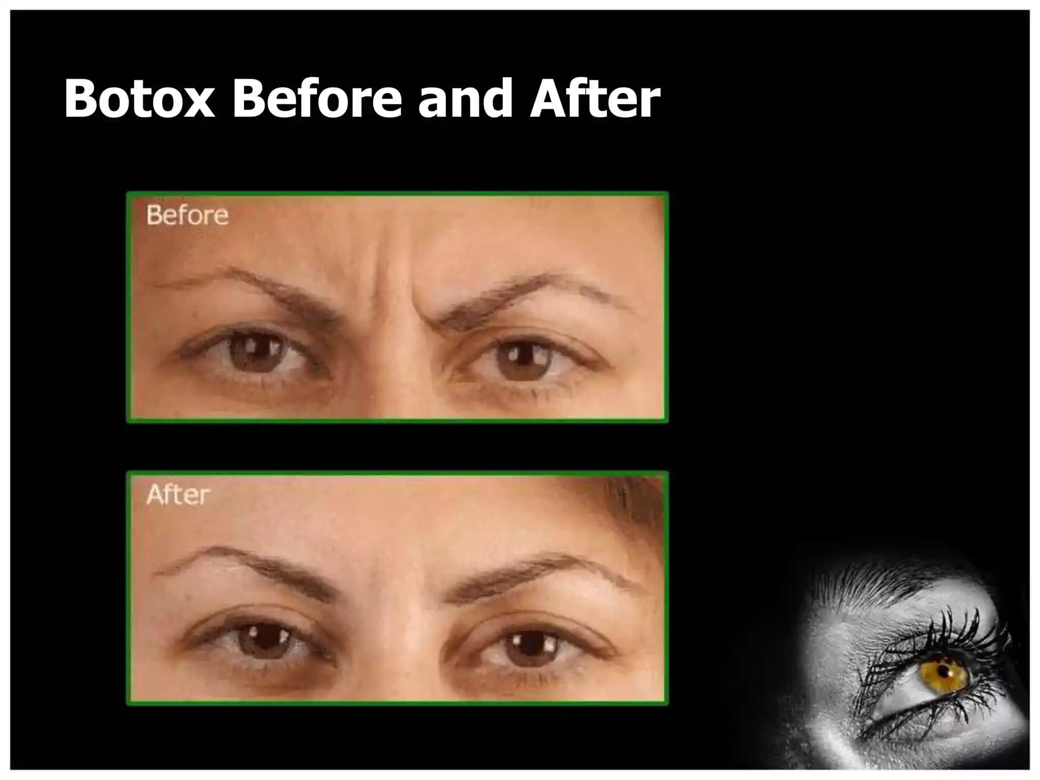 45 Yaş Üstü Kadınlarda Botox Kullanımı: Başlama Yaşı, Etkiler ve Deneyimler
