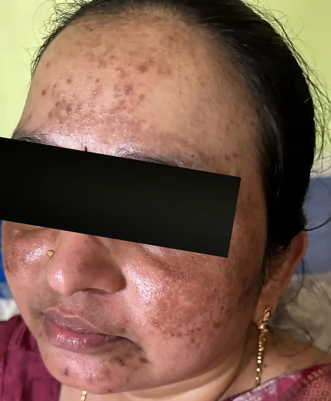 5 Yıllık Pigmentasyon ve Akne Sorunlarında Doğru Tedavi Yöntemleri ve Değerlendirmeler