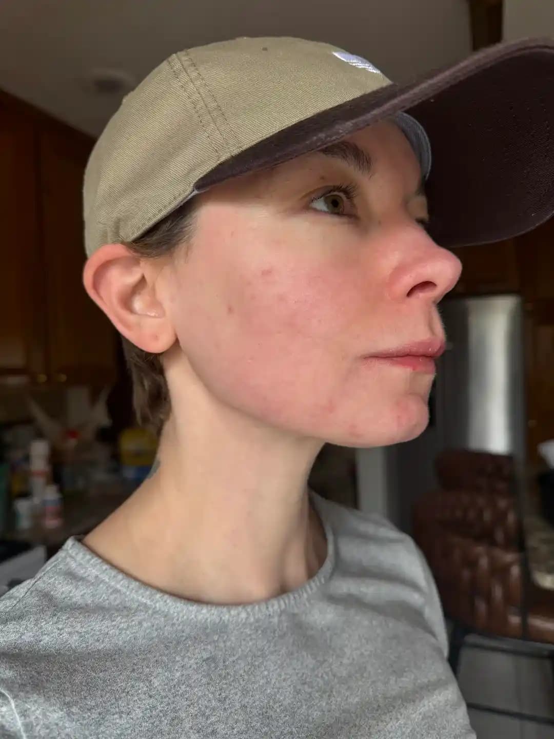 Accutane Kullanımı ve Uzun Süreli Akne Tedavisinde Etkili Sonuçlar ve Yönetim