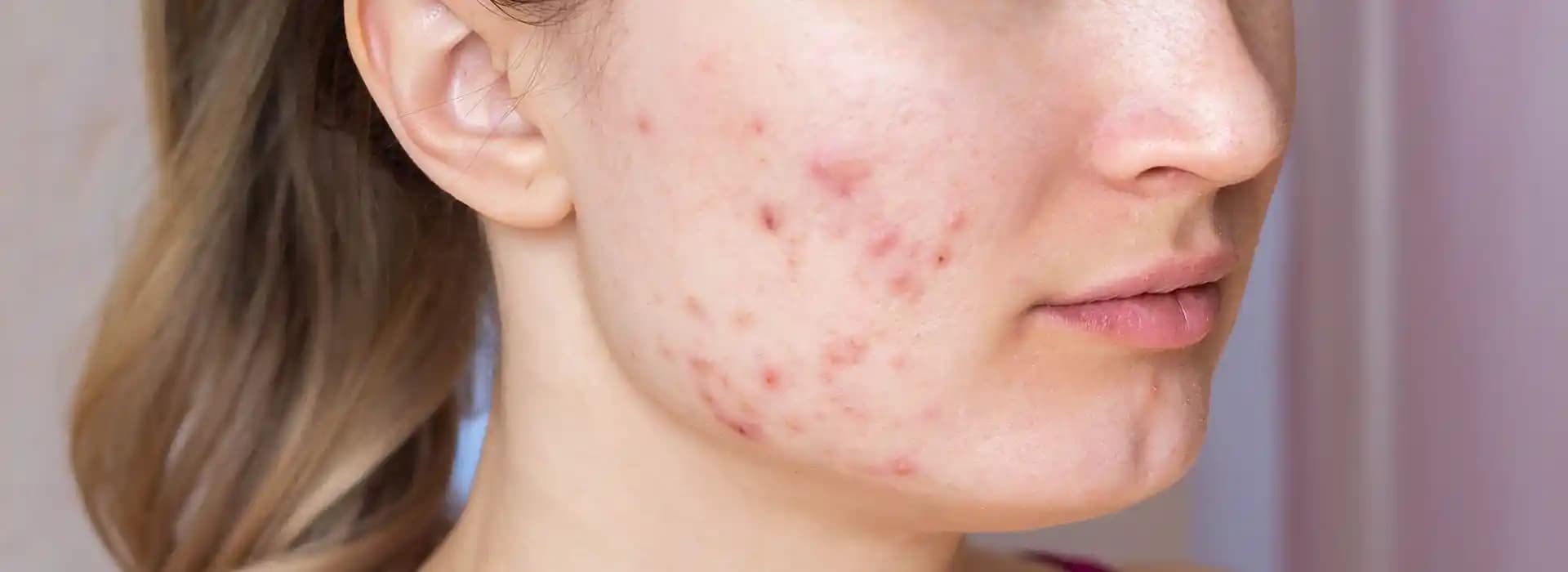 Akne Tedavisinde Karşılaşılan Zorluklar ve Dirençli Vakaların Yönetimi