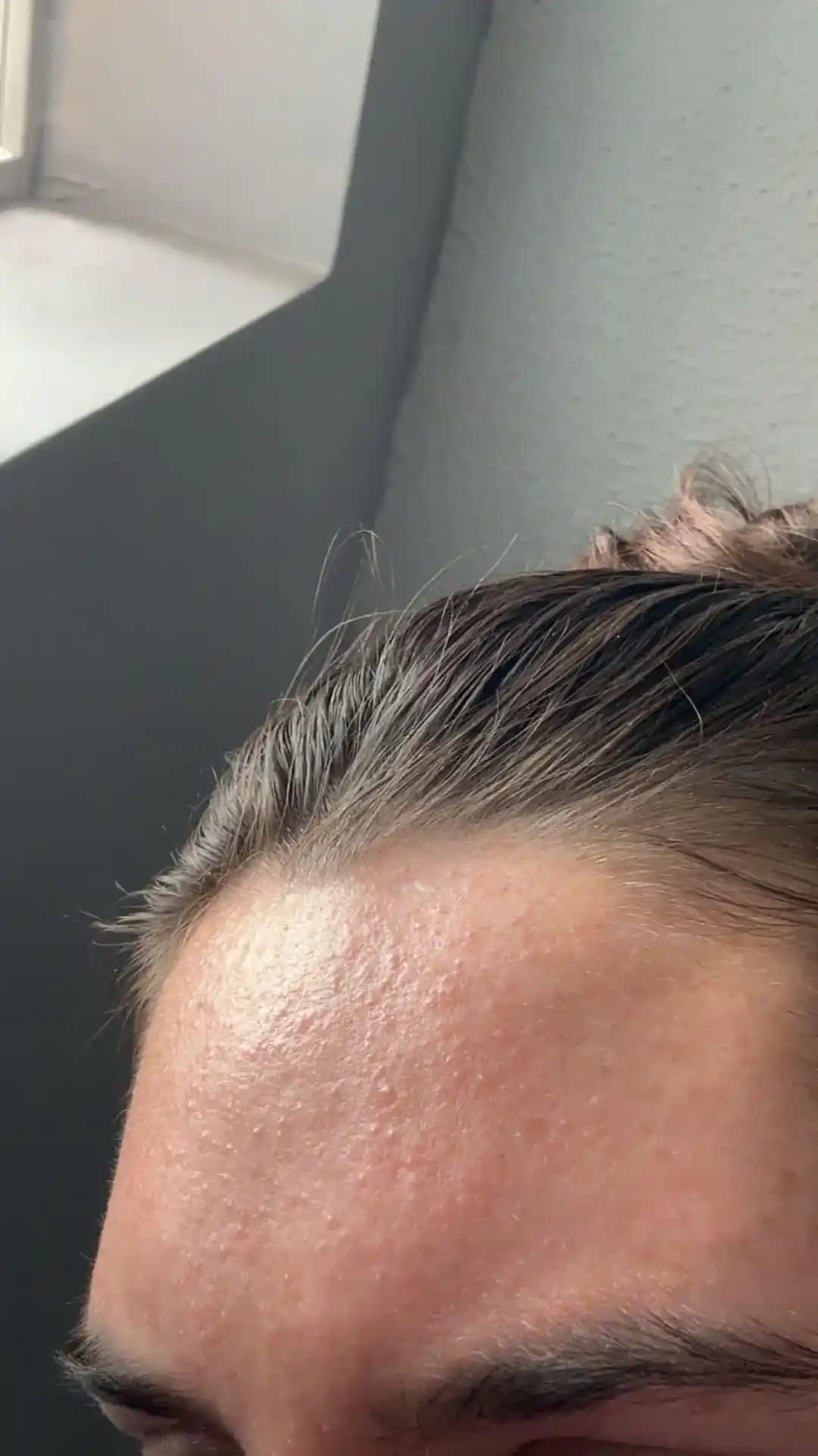 Alın Bölgesindeki Kabarcıkların Nedenleri ve Benzoyl Peroksit ile Etkili Cilt Bakımı