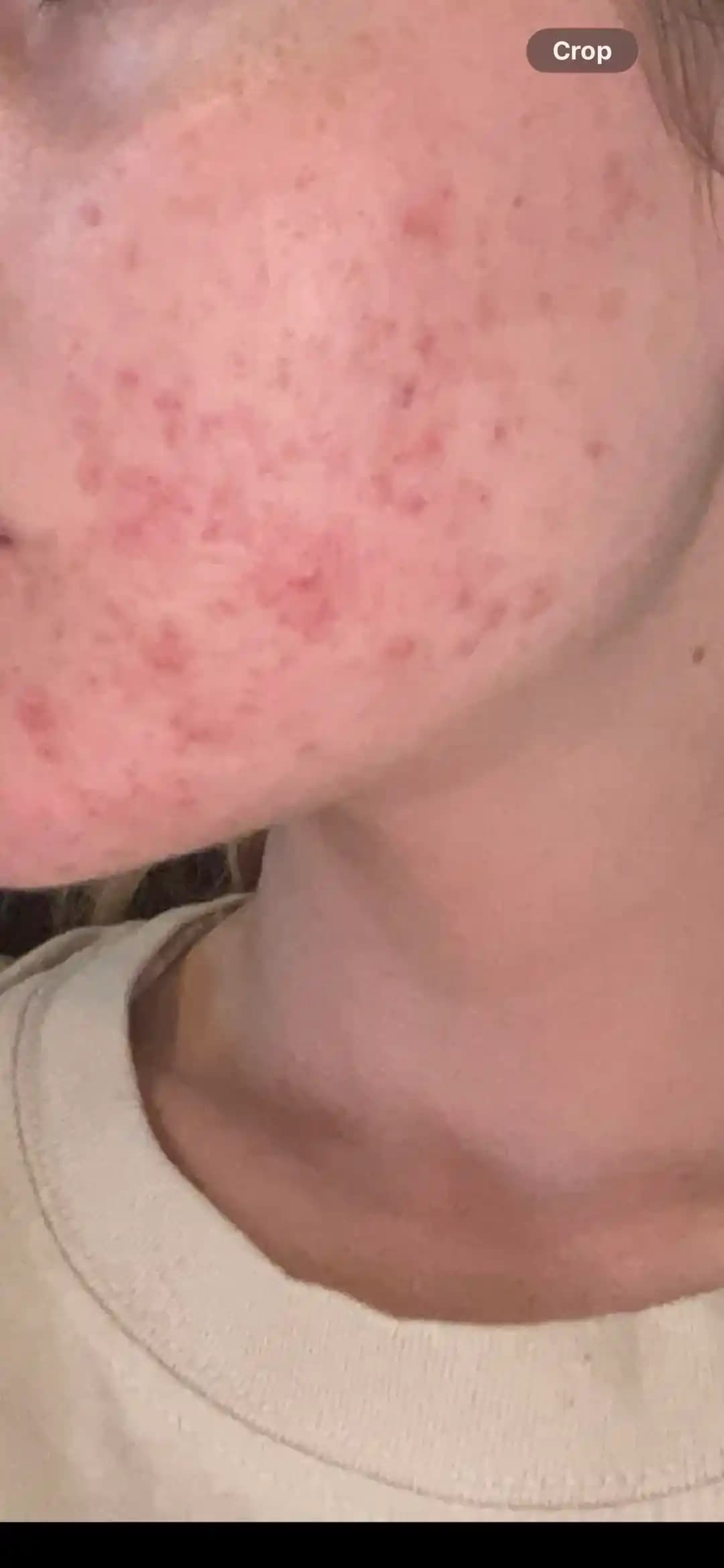 Hormonal Akne Tedavisinde Doğum Kontrol Haplarının Rolü ve Cilt Bakım Rutinleri