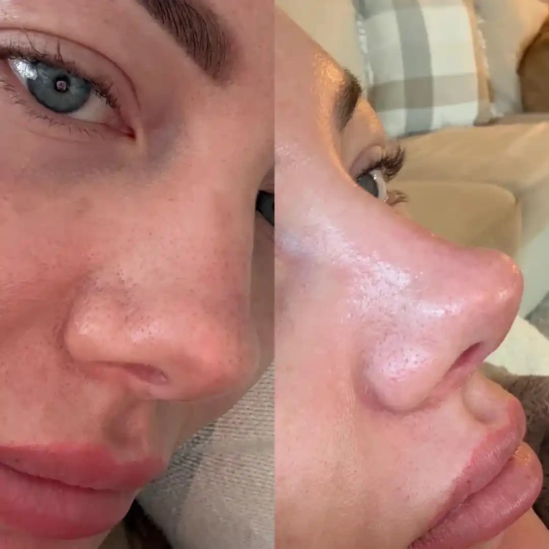 Ilso Sebum Melting Ürünü ile Gözenek Temizliği ve Siyah Nokta Giderme Yöntemleri