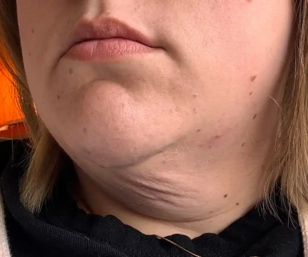 Kilo Kaybı Sonrası Boyun Sarkıklığı: Nedenleri, Tedavi Yöntemleri ve Cerrahi Seçenekler