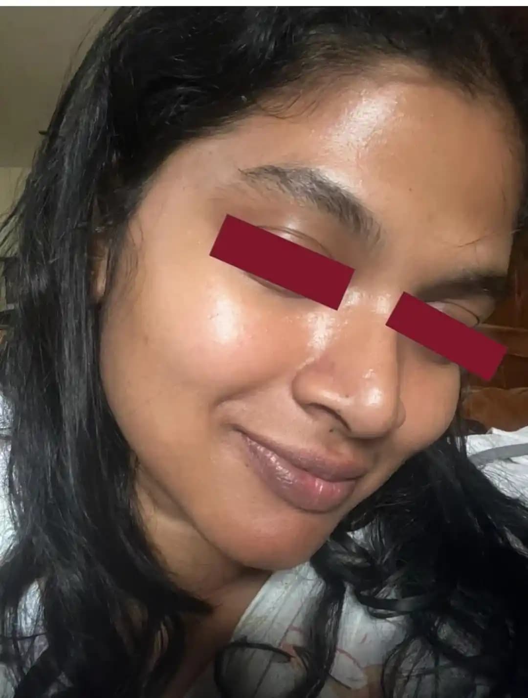 Yüzdeki Kabarcıkların Nedenleri ve Cilt Bariyerinin Onarımı Yöntemleri