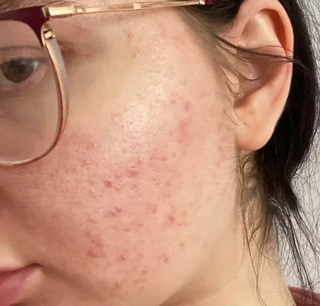 Adapalene Kullanımı ve Ciltteki Etkileri: 8 Haftalık Deneyim ve Bakım Yöntemleri