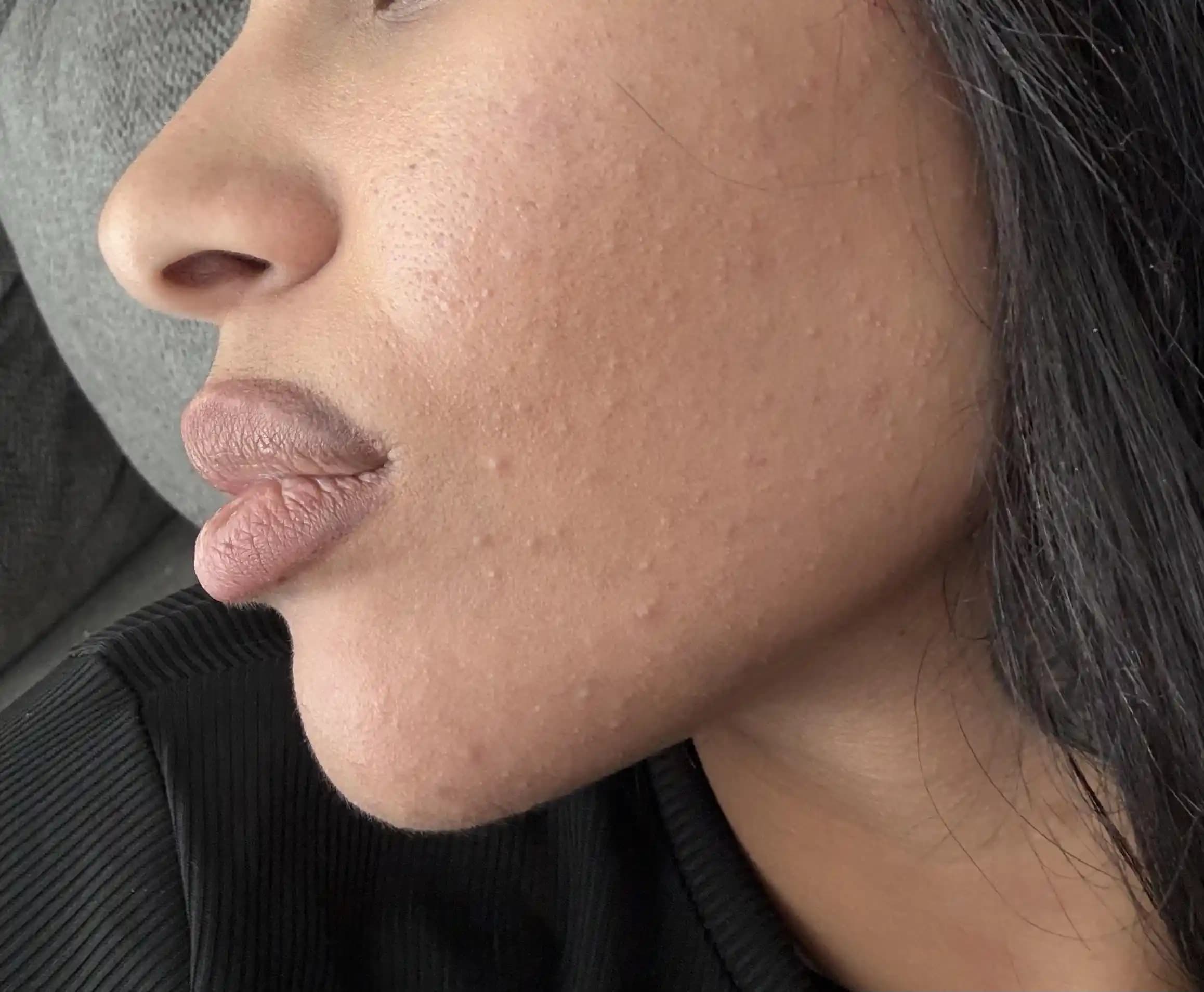 Akne Tedavisinde Cilt Tipine Uygun Yöntemler ve Dermatolog Kontrolünün Önemi