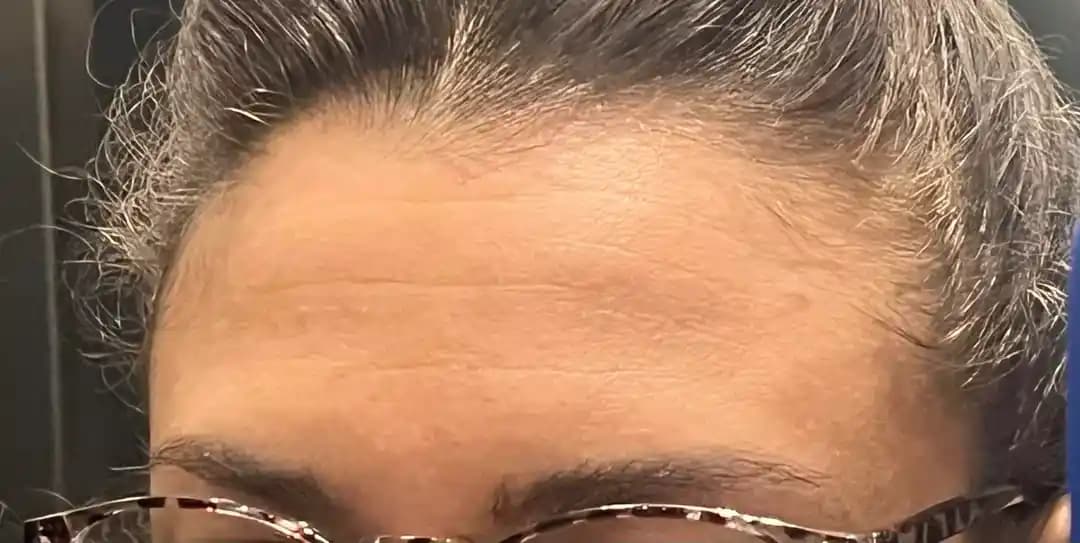 Alın Kırışıklıkları İçin Botox ve Alternatif Tedavi Yöntemleri: Etkiler ve Riskler