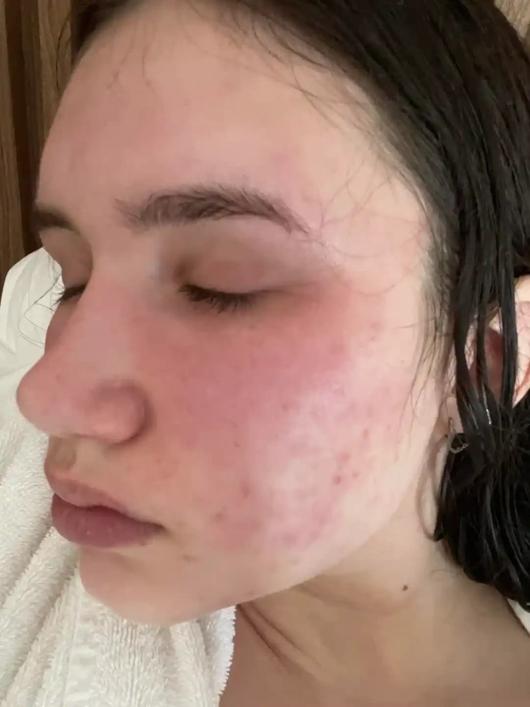 Ani Yüzdeki Akne Patlamalarının Nedenleri ve Etkili Tedavi Yöntemleri