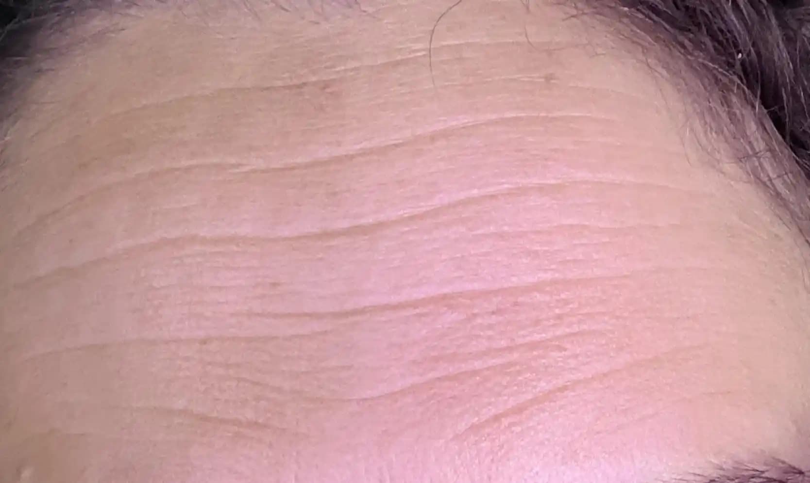 Derin Alın Çizgileri İçin Botox: Etkileri, Maliyetleri ve Alternatif Tedavi Yöntemleri