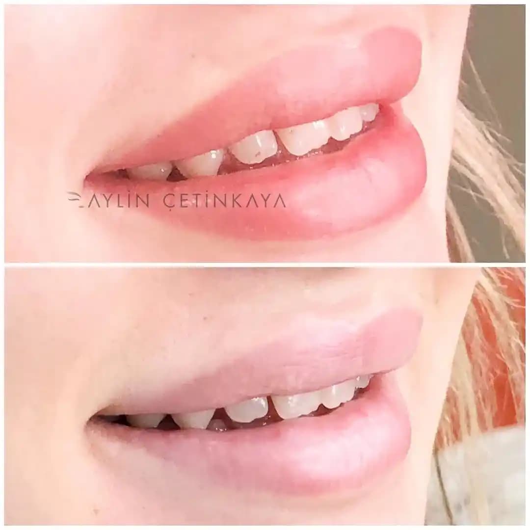 Dudaklarda Beyaz Köprü Görünümü ve Makyajla Gizleme Yöntemleri Hakkında Bilgi