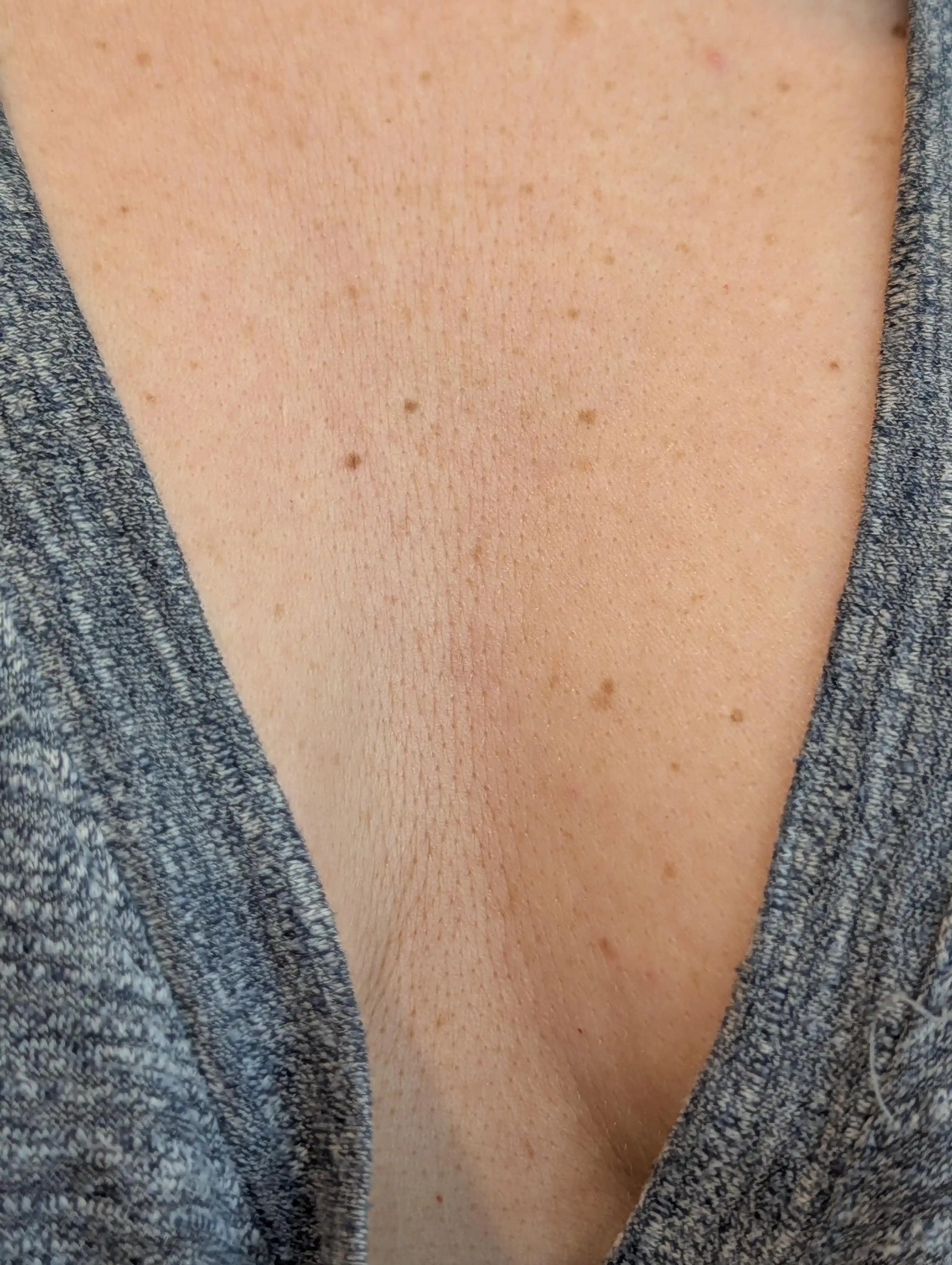 Göğüs Bölgesi Cilt Bakımında Microneedling, Lazer ve Destek Yöntemleriyle Yaşlanma Önleme