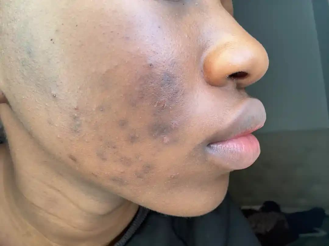 Hiperpigmentasyon ve Koyu Akne İzleri İçin Etkili Tedavi Yöntemleri ve Aktif Bileşenler