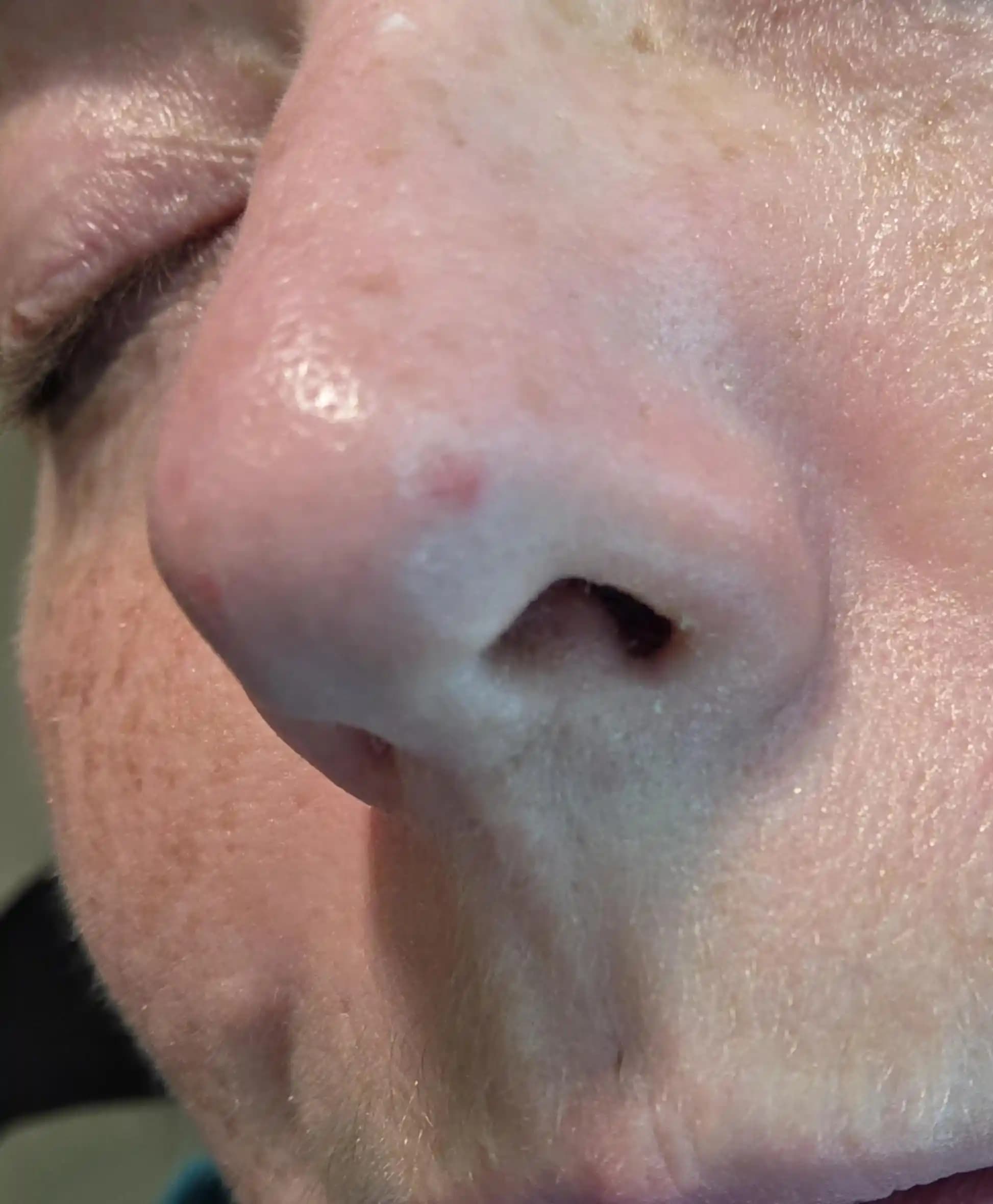 Kırmızı Bazal Hücreli Karsinom: Tanı, Tedavi Yöntemleri ve Koruyucu Önlemler