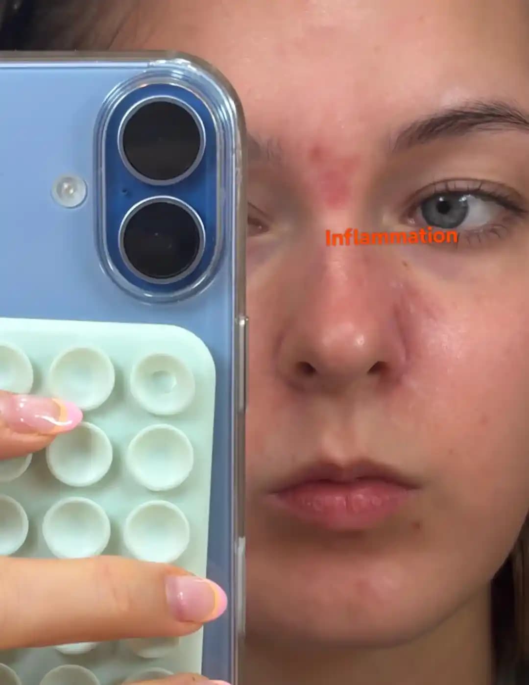 Kistik Akne Nedenleri, Tedavi Yöntemleri ve Uzun Vadeli Önleme Stratejileri