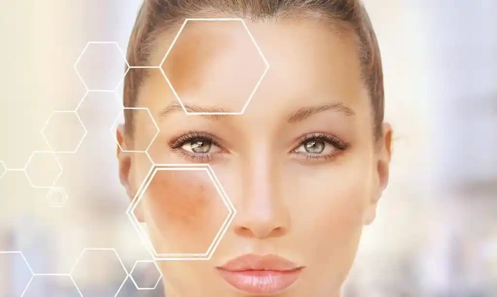 Koyu Leke Tedavisinde Güneş Koruyucunun Kritik Rolü ve Doğru Kullanım Yöntemleri