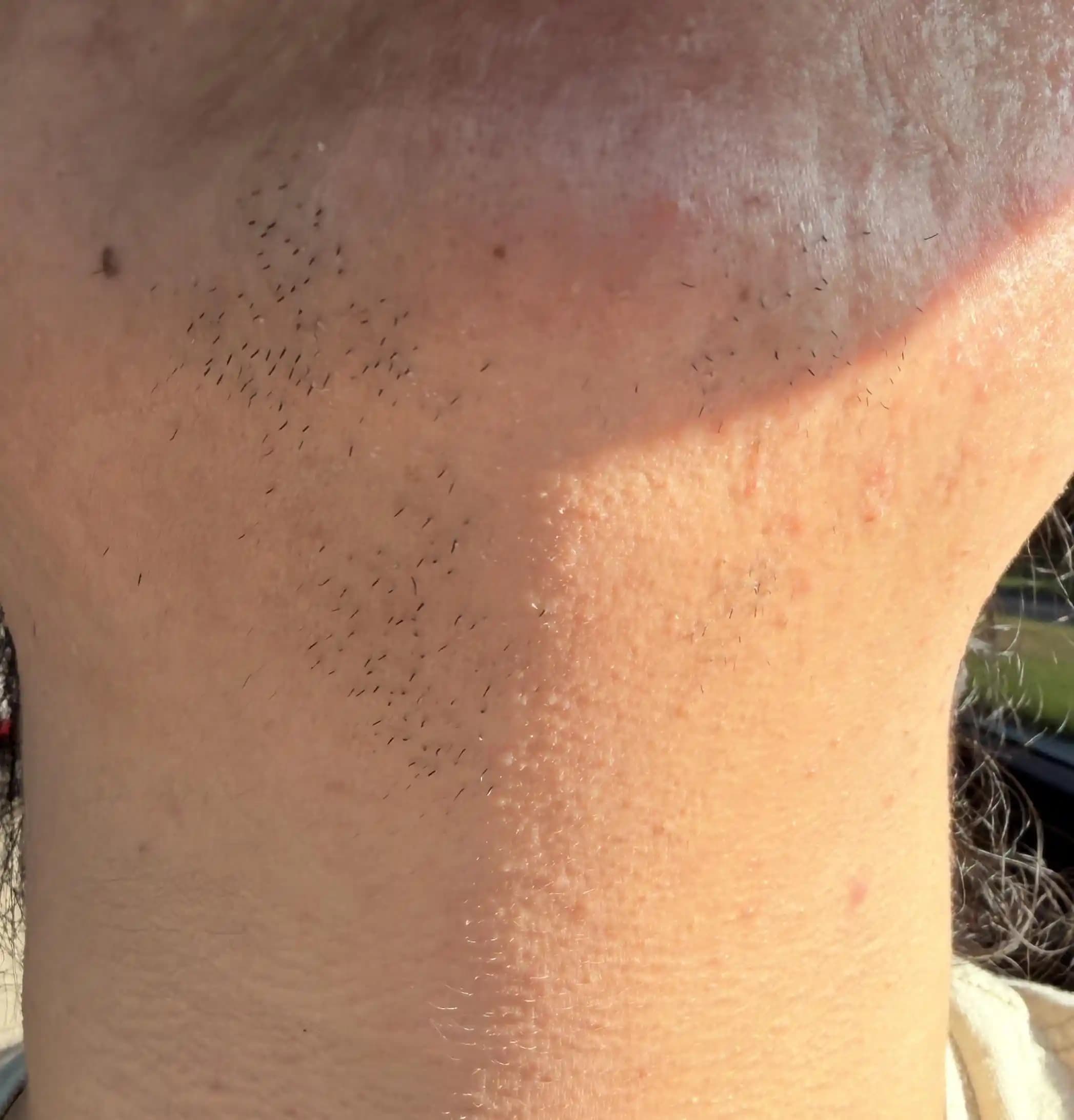 Yüz Bölgesinde Lazer Epilasyon ve Elektroliz Yöntemlerinin Karşılaştırmalı Analizi