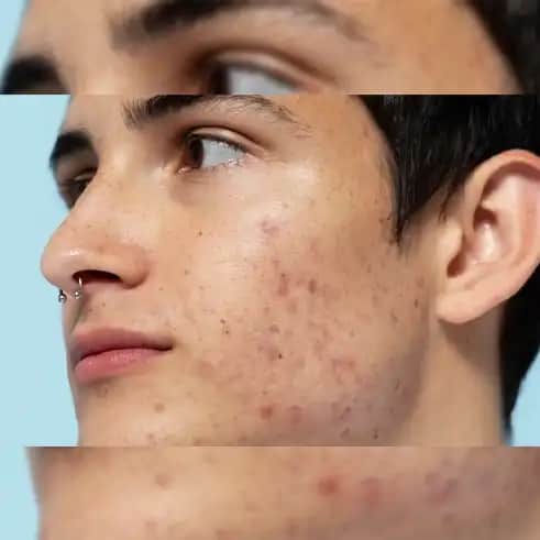 10 Yaşında Sivilce Nedenleri ve Çocuklarda Cilt Değişiklikleri Hakkında Bilgiler