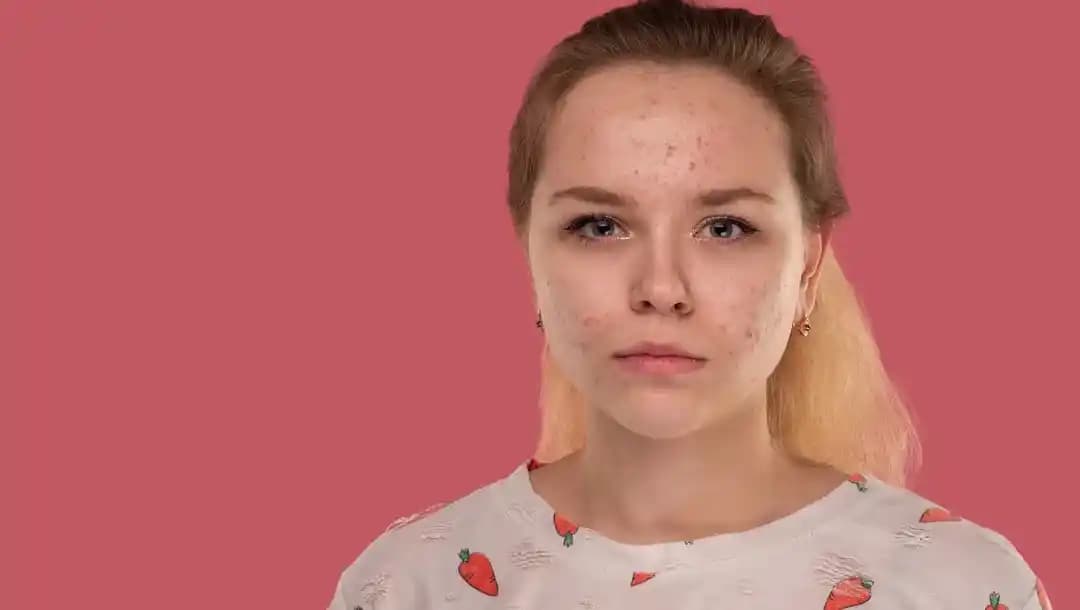 11 Yaş Sivilceleriyle Mücadele ve Sağlıklı Cilt Bakımı Rehberi