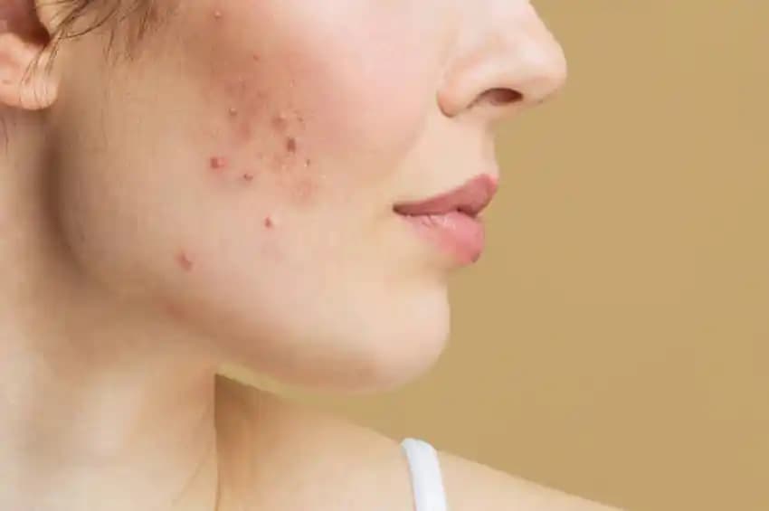 4 aydır geçmeyen sivilcelerle başa çıkma yolları ve etkili tedavi yöntemleri