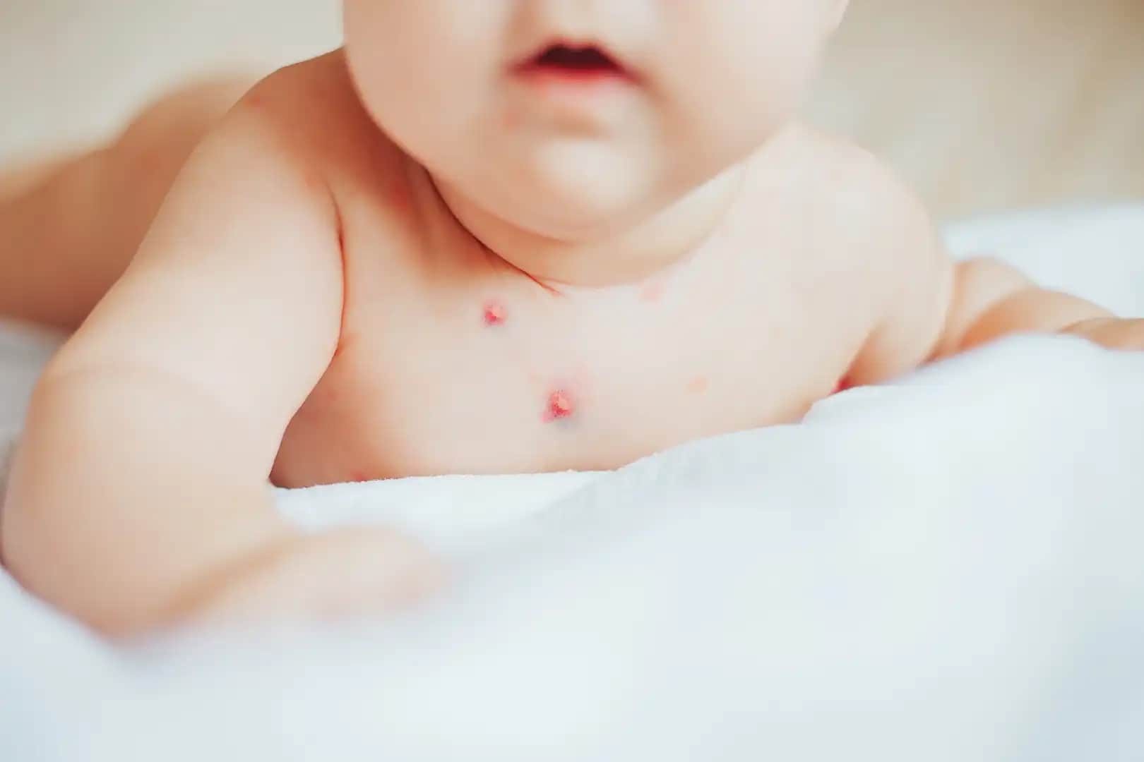 4 Yaşındaki Çocuklarda Yüzde Sivilce: Nedenleri ve Doğal Çözüm Yolları