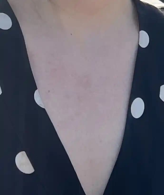 6 aydan uzun süren sivilceler: nedenleri ve etkili tedavi yöntemleri