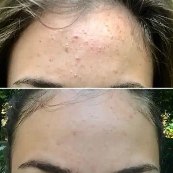 6 Yaşındaki Çocuklarda Sivilce Nedenleri ve Etkili Çözüm Yolları