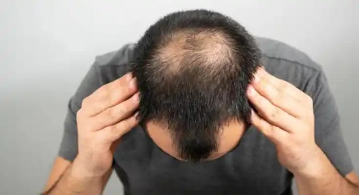 Adana'da Saç Ekimi Fiyatları ve Kalite Seçenekleri Hakkında Güncel Bilgiler