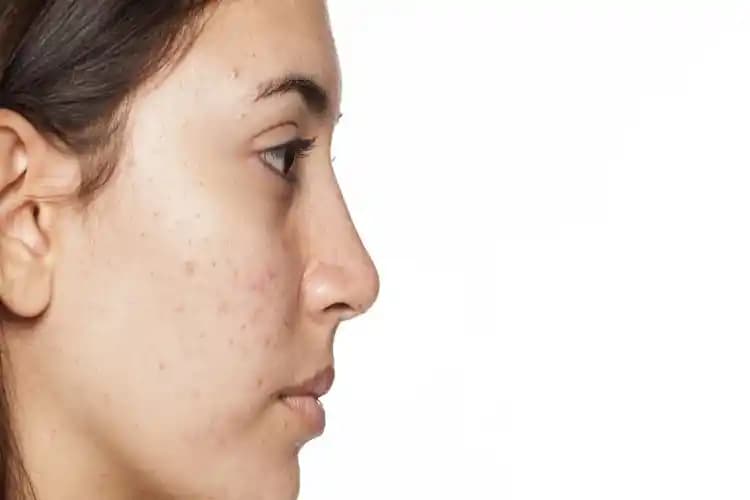 Adet Döneminde Sivilce Sorunu ve Etkili Çözüm Yolları