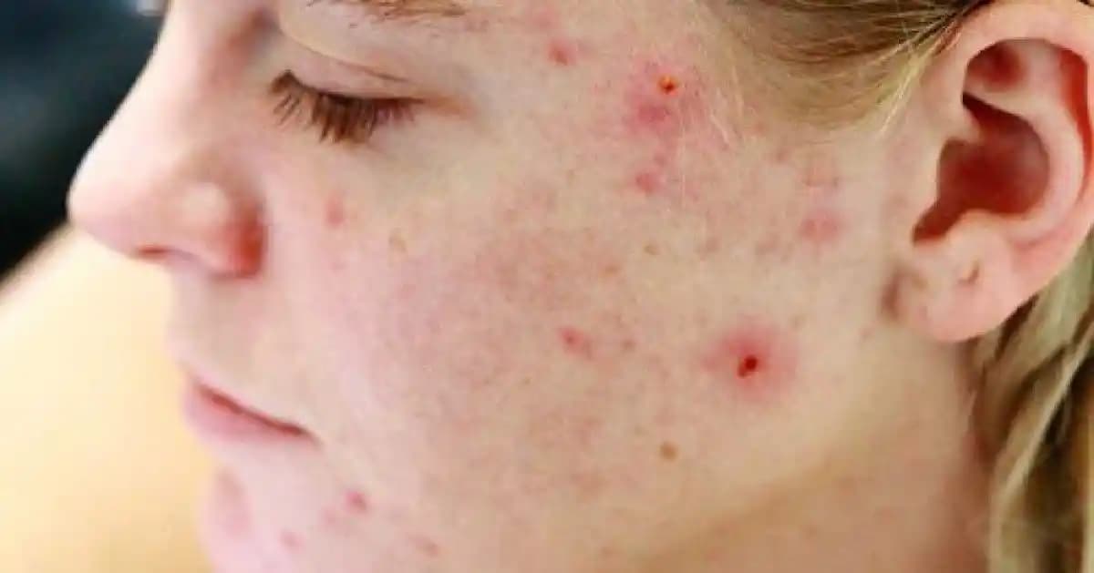 Adetten Önce Sivilce Çıkma Süresi ve Cilt Sağlığına Etkileri Hakkında Detaylı Bilgi