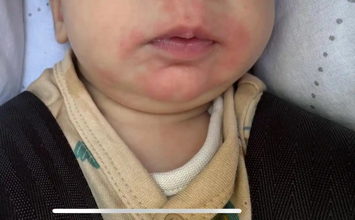 Ağız Çevresi Kızarıklığı Nedenleri, Belirtileri ve Etkili Çözüm Yolları