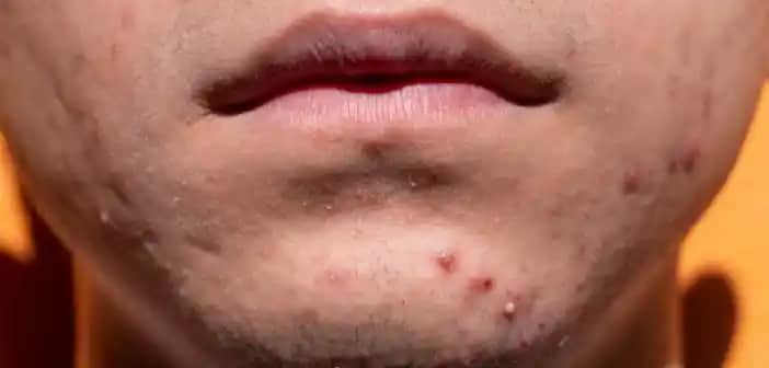 Akne Belirtileri, Türleri ve Etkili Tedavi Yöntemleri Hakkında Detaylı Bilgi