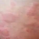 Alerji ve Kırmızı Lekelerle Mücadelede Bilinçli Kozmetik Kullanımı ve Cilt Bakımı İpuçları