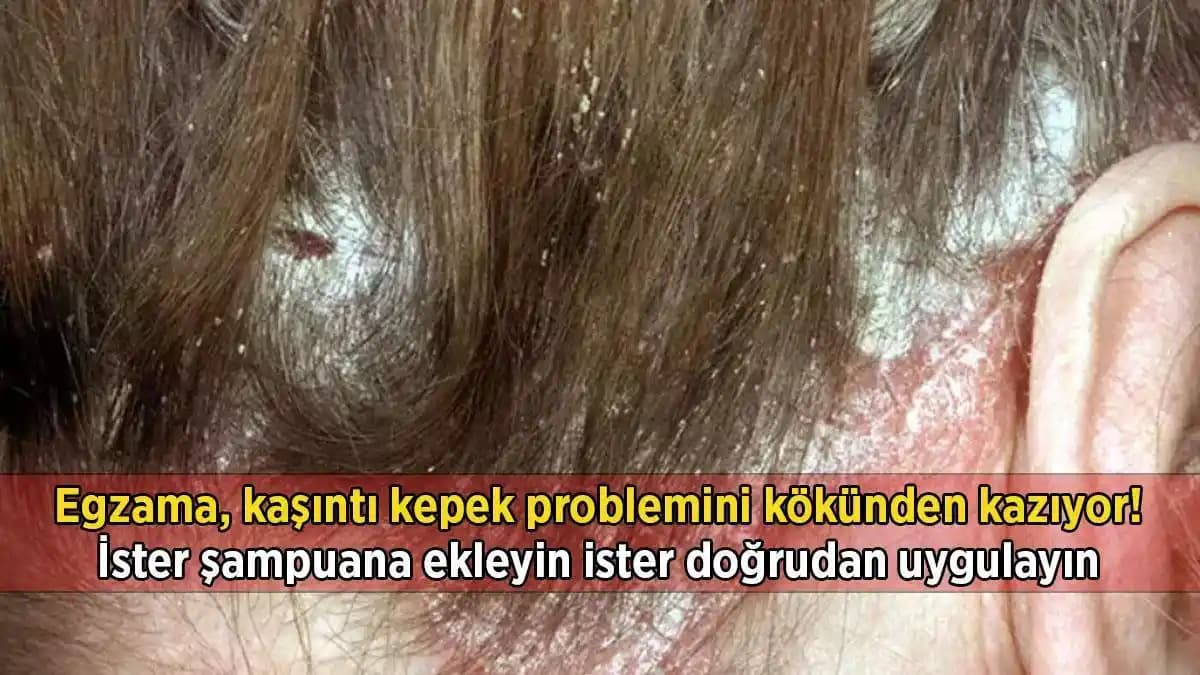 Aşırı Kepek ve Kaşıntı Problemlerine Kozmetik Yaklaşımlarla Etkili Çözüm Yolları