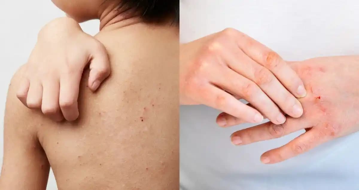 Atopik Cilt Belirtileri ve Yönetimi: Güncel Bilgilerle Cilt Sağlığı Rehberi