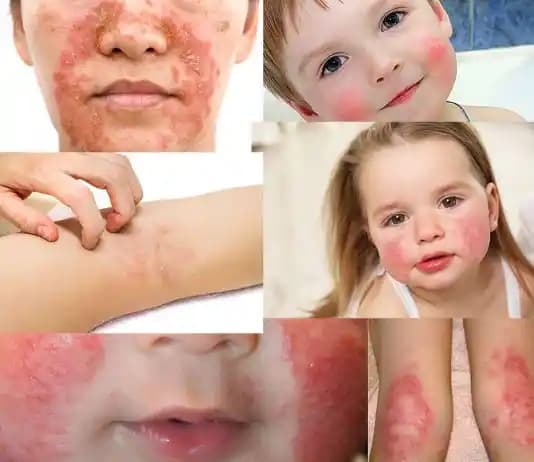 Atopik Dermatit ve Kozmetik Ürünlerin Doğru Seçimi ile Cilt Sağlığını Koruma