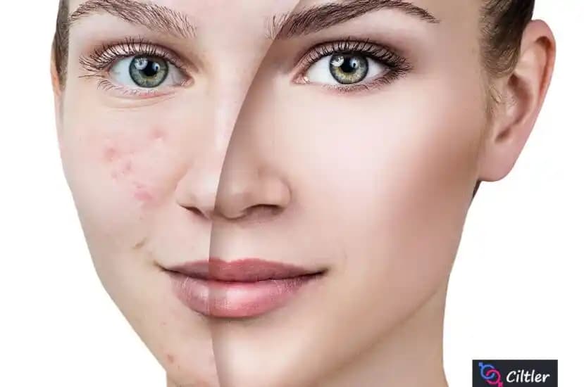 Ayak Altında Çıkan Sivilcelerin Nedenleri ve Etkili Çözüm Yöntemleri