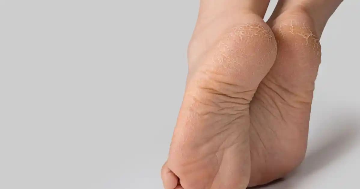 Ayak Çatlamaları ve Kozmetik Yaklaşımla Sağlıklı Ayaklar İçin Bilmeniz Gerekenler