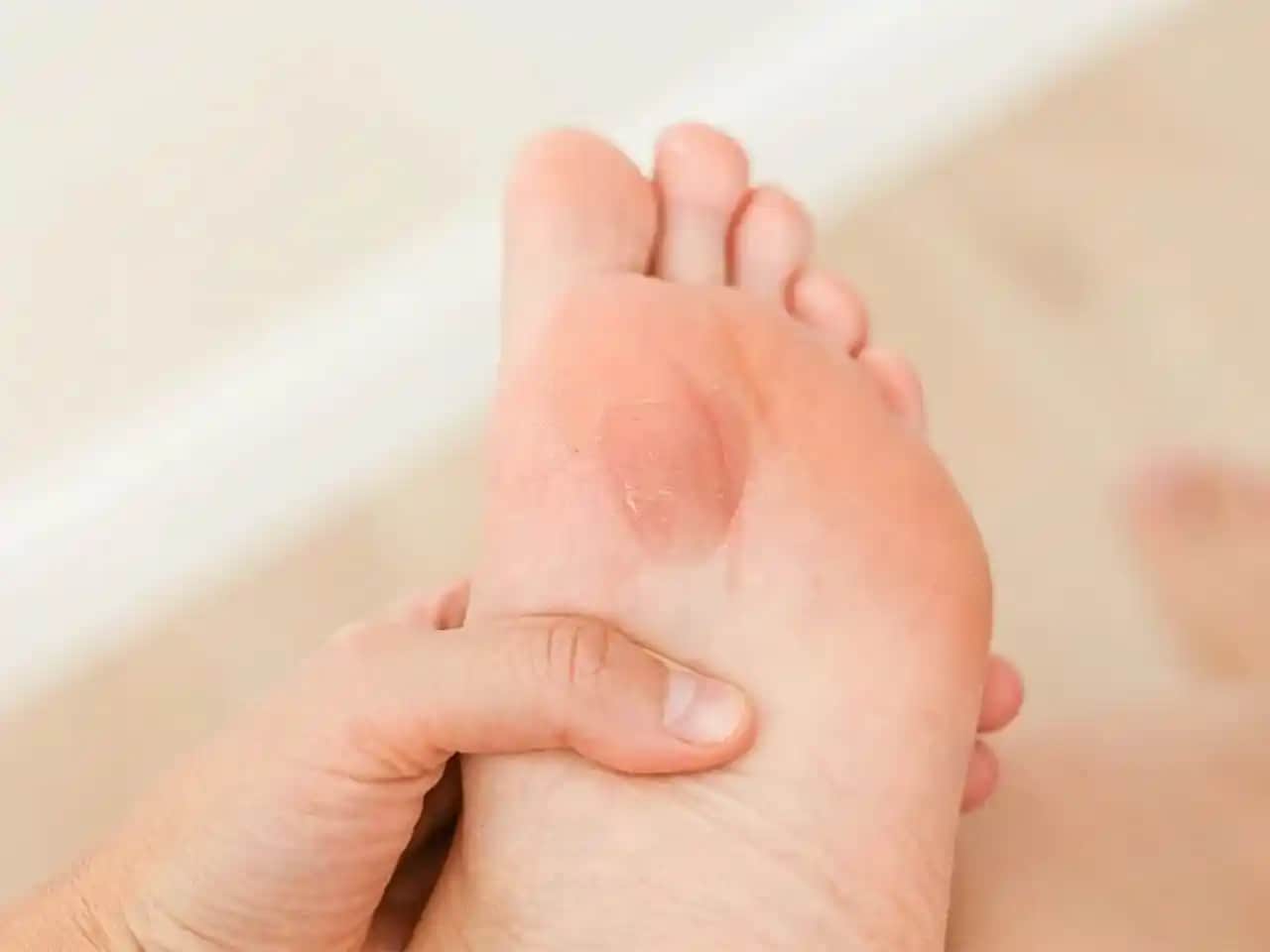 Ayak Nasırına Karşı Doğal ve Etkili Çözüm Yöntemleri Hakkında Bilgiler