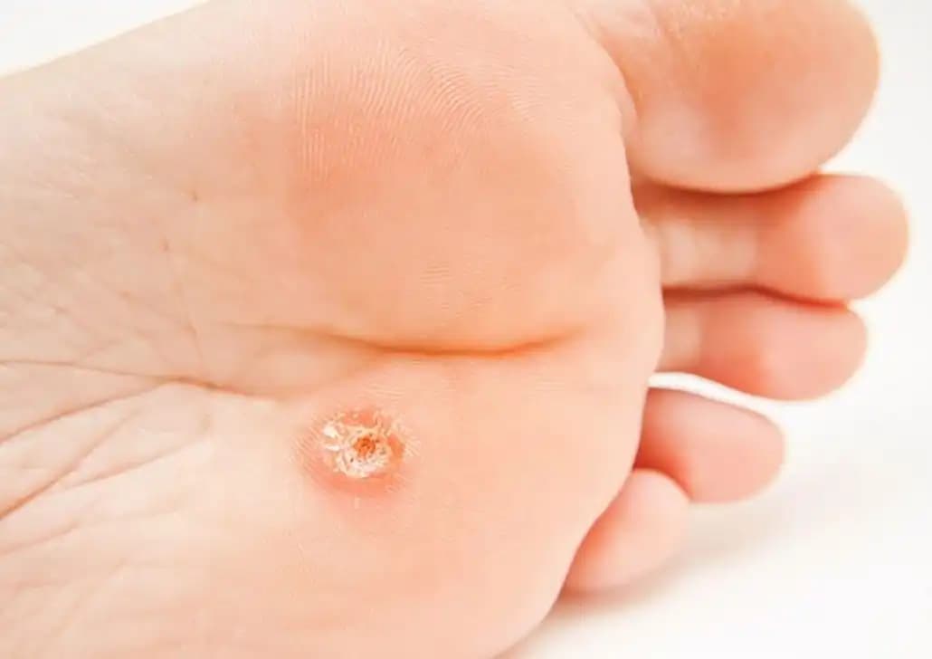 Ayak Nasırlarına Karşı Bilinçli Bakım ve Doğal Çözüm Yöntemleri Rehberi