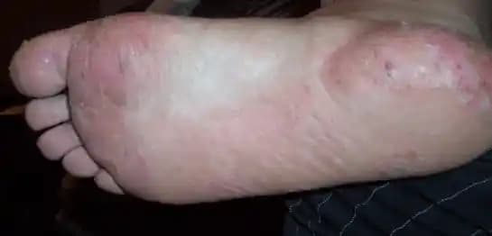 Ayaklarda Egzama Nedenleri Belirtileri ve Etkili Tedavi Yöntemleri