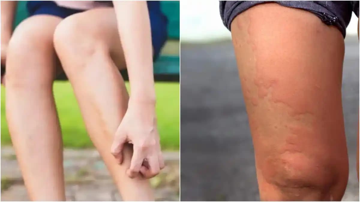 Bacak Kızarıklığını Giderici Yöntemler ve Nedenleri Hakkında Detaylı Bilgi