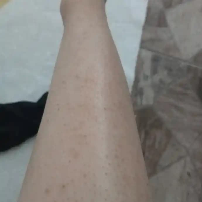 Bacaklarda Siyah Lekeler: Nedenleri, Belirtileri ve Etkili Çözüm Yöntemleri