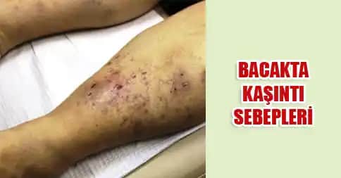 Bacakta Kaşıntı ve Yara Sorunlarının Nedenleri ve Tedavi Yöntemleri