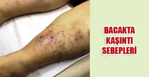 Bacakta Kaşıntı ve Yara Sorunlarının Nedenleri ve Tedavi Yöntemleri