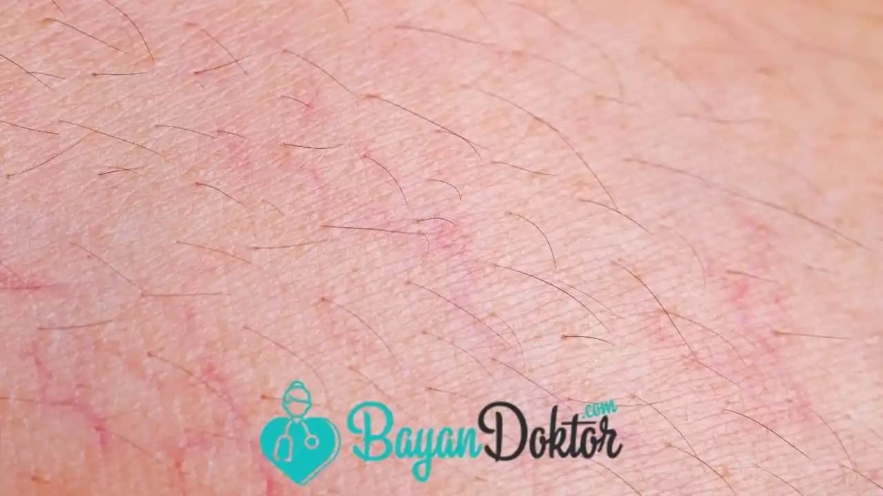 Bacakta Mor Çatlaklar Nedenleri ve Önleme Yöntemleri Hakkında Detaylı Bilgi