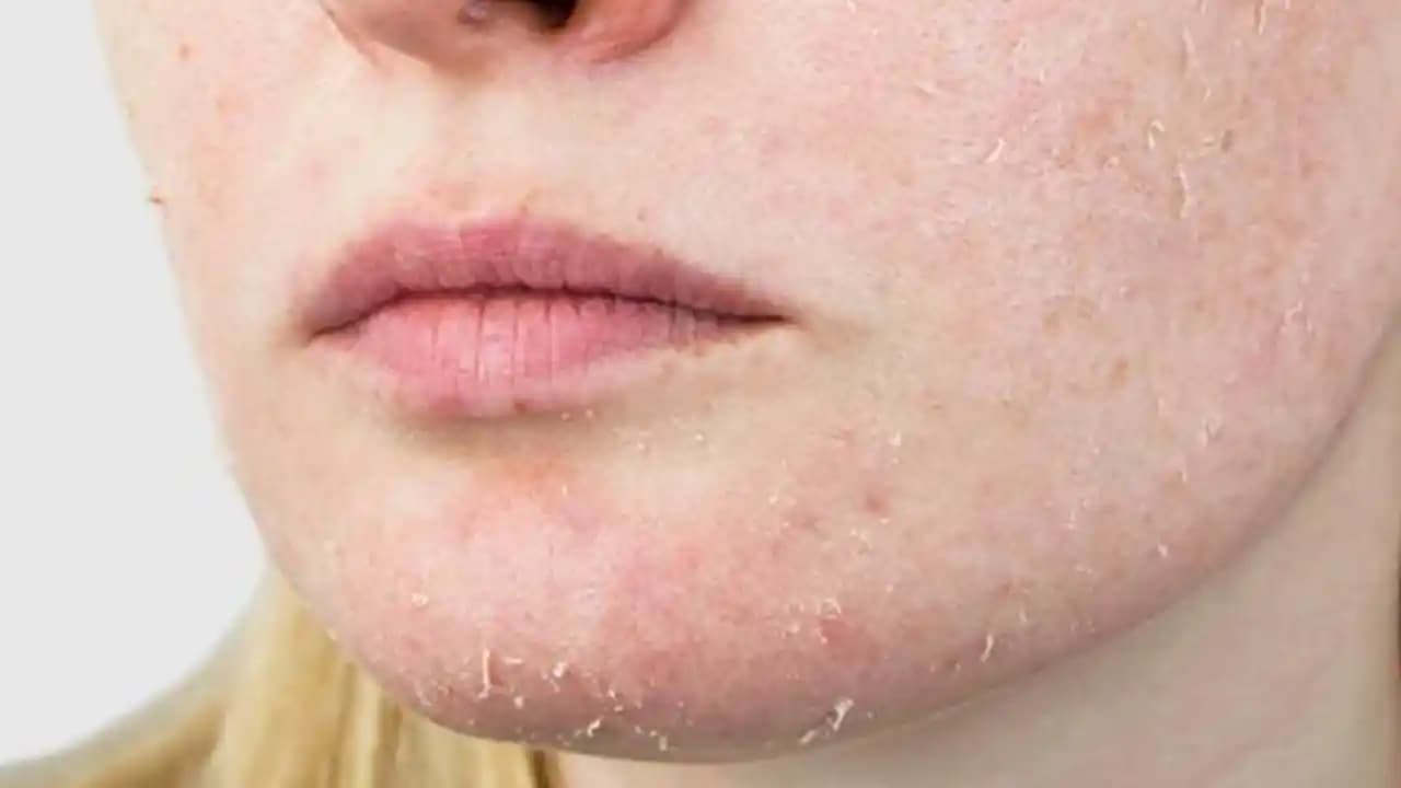 Bacakta Pul Pul Dökülmenin Nedenleri ve Etkili Çözüm Yöntemleri