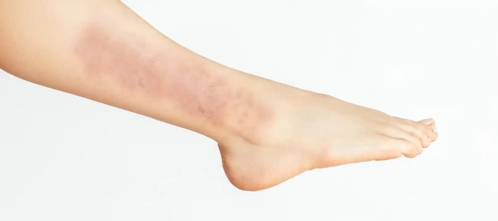 Bacakta Yaralar ve Bakım Yöntemleri: Nedenleri, Türleri ve Sağlıklı Cilt İçin İpuçları