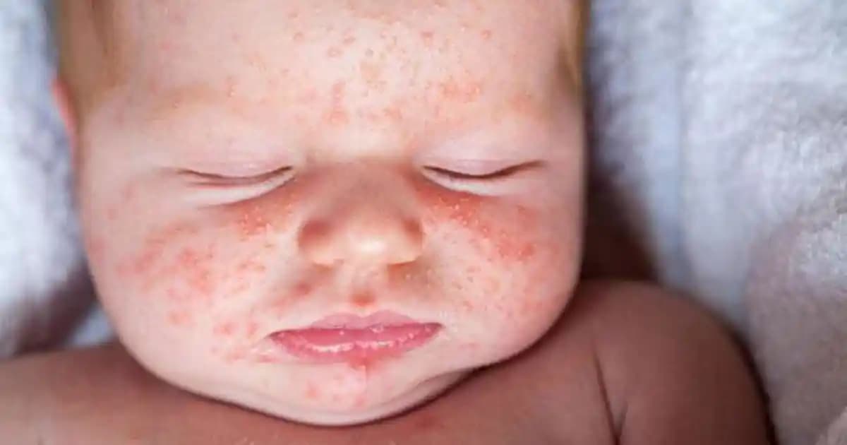 Bebek Cildinde Kırmızı Noktalar: Nedenleri, Çözümleri ve Kozmetik Yaklaşımlar