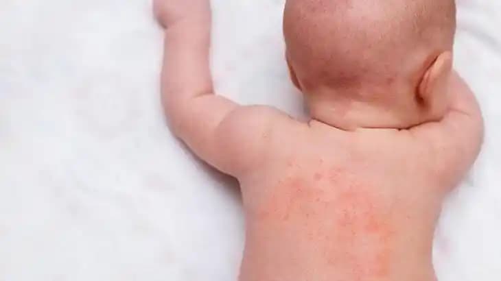 Bebeklerde Boyun Kızarıklığı ve Güvenli Kozmetik Kullanımı Hakkında Bilgiler